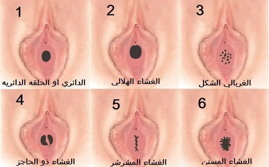 ترميم غشاء البكارة | Hymenoplasty illustrative image