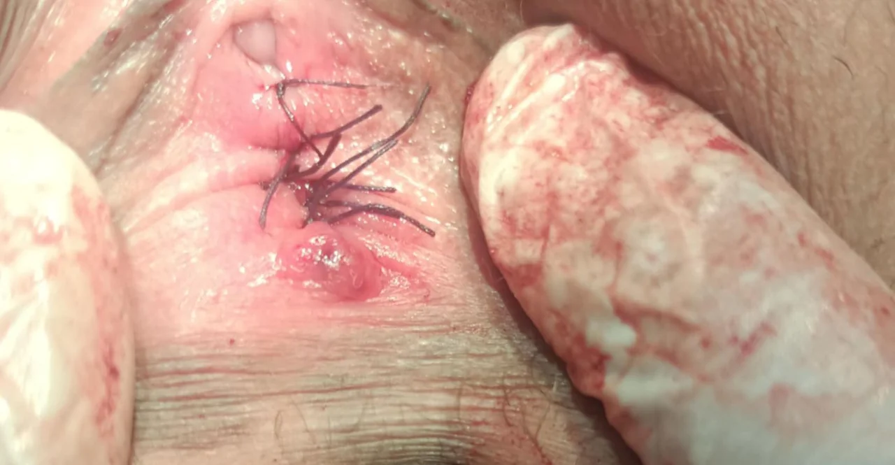 غشاء بكارة صناعي | Hymenoplasty illustrative image