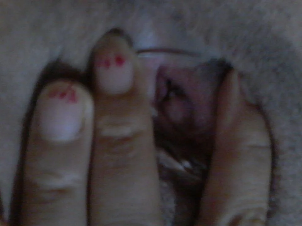 متى يمكن الجماع بعد الترقيع؟ | Hymenoplasty illustrative image